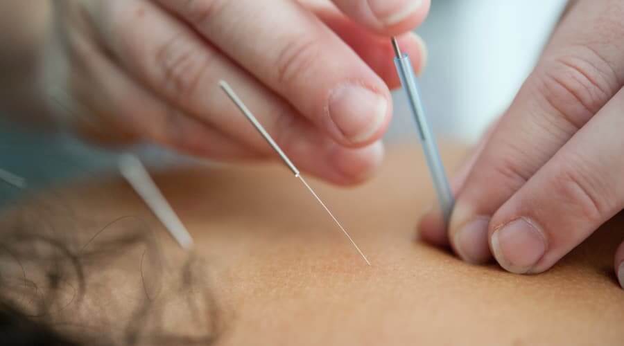 Bild: Akupunktur, Akupunktur ist ein Bestandteil der „Traditionellen chinesischen Medizin“.