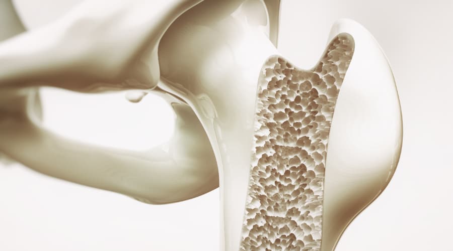 Bild: Osteoporosetherapie Knochendichte Messungen, Osteoporose ist eine sehr häufige Knochenerkrankung